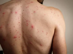 Un brote de sarampión por falta de vacunación deja ya nueve niños muertos en Israel