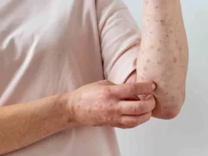 SP detecta dos casos de mpox (viruela símica) en destacamento policial en San Cristóbal